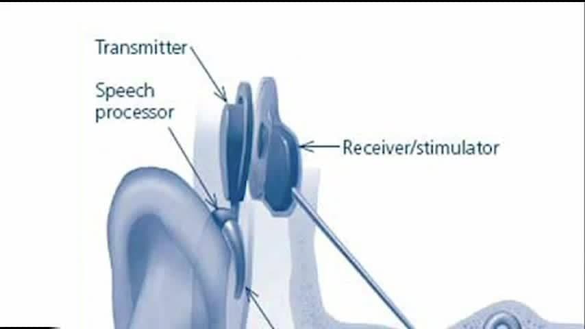 Cochlear Implants: Determining if a cochlear implant is needed